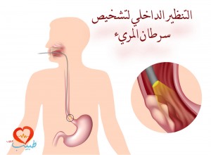 يعتبر التنظير الداخلي endoscopy الخطوة الأولى لتقييم سرطان المرىء