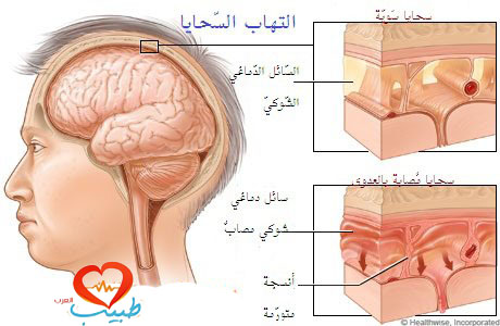 التهاب السحايا الفيروسي Viral Meningitis