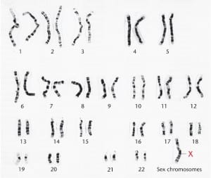 07_07b-Turner_syndrome