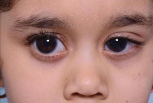 Pediatric Glaucoma Review of Ophthalmology-5