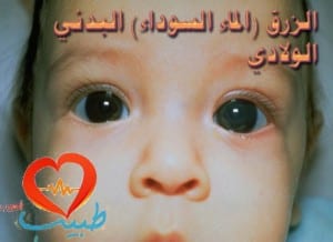 glaucoma-congenital