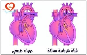 طبيب ع قلبية قناة شريانية