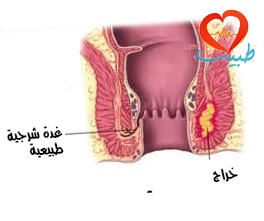 طبيب عرب جراحة هراج
