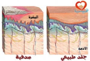 طبيب عرب جلد صدفية