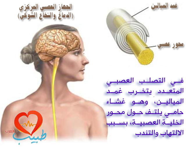طبيب عرب عصبية تصلب