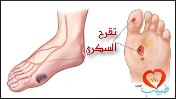 قرحة القدم السكرية Diabetic Foot Ulcer