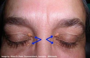 Xanthelasma