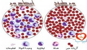 طبيب ع دم ابيضاض لمفاوي مزمن