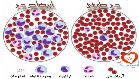 ابيضاض الدم اللمفاوي الحاد