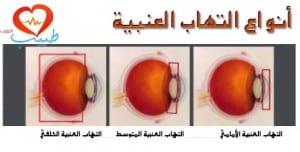 طبيب ع عيون التهاب عنبية