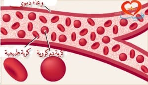 طبيب عرب دم كروي