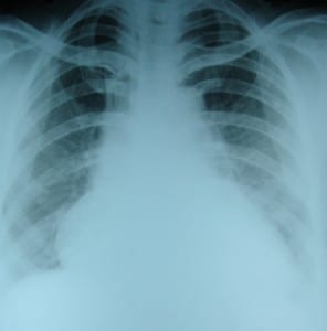 CXR-in-heart-failure