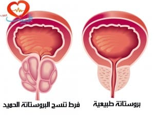 طبيب ع بولية تضخم بروستاتة 1