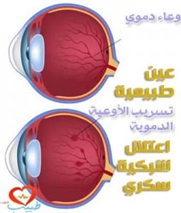 طبيب ع عيون اعتلال شبكية سكري