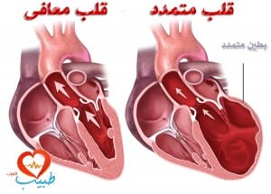اعتلال عضلة القلب المتمدد