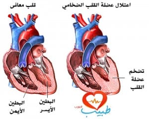 اعتلال عضلة القلب الضخامي