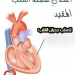 اعتلال عضلة القلب المقيد
