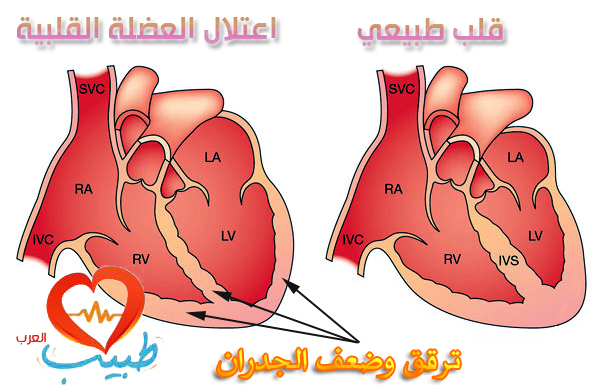 اعتلال عضلة القلب Cardiomyopathy