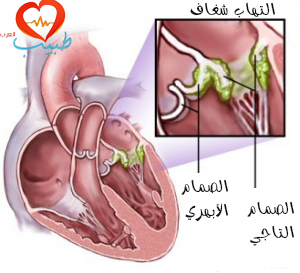 طبيب ع قلبية التهاب شغاف 1