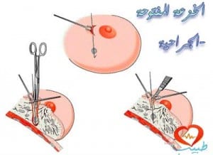 طبيب ع نسائية خزعة ثدي 1