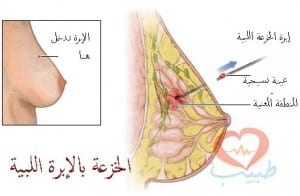 طبيب ع نسائية خزعة ثدي