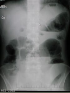 Upright_abdominal_X-ray_demonstrating_a_bowel_obstruction