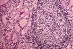 hashimotos-follicle-thyroid-glands-2-1024x691