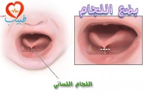 طبيب ع اطفال التصاث اللسان بضع اللجام