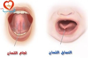 طبيب ع اطفال التصاق اللسان