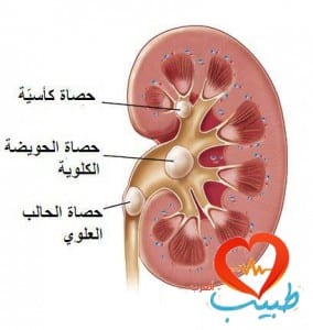 طبيب ع بولية الحصيات