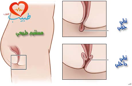 هبوط المستقيم أو تدلي الشرج Rectal Prolapse هبوط المستقيم بالصور