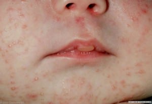 حب الشباب عند الرضع (Infantile acne)