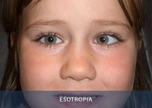 esotropia-copy1