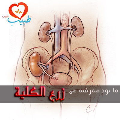 زرع الكلية ، زراعة الكلى Kidney Transplantaion