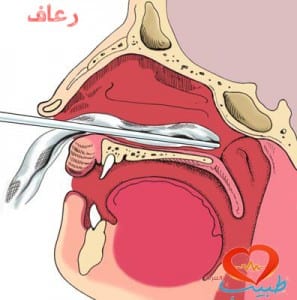 طبيب ع انف رعاف علاج 2