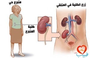 زراعة الكلى Kidney Transplantaion