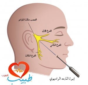 الترددات الراديوية الحرارية لعلاج ألم العصب مثلث التوائم