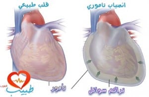 طبيب ع قلب انصباب تامور