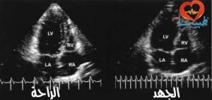 طبيب ع قلبية رسم القلب على الجهد