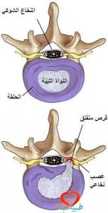 طبيب ع مفاصل فتق رقبي