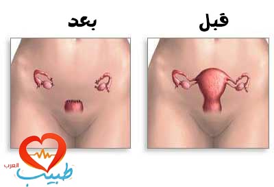 استئصال الرحم hysterectomy (أسبابه وأنواعه ومضاعفاته)