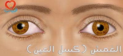 الغمش ( amblyopia )