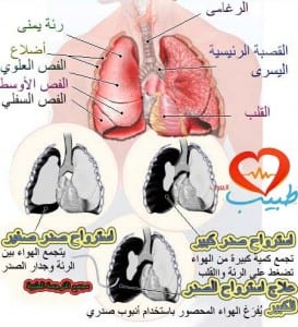 طبيب ع تنفسية استرواح  2