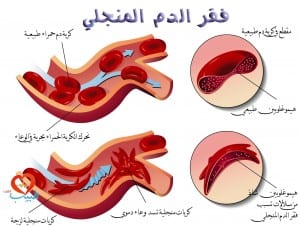 medical illustration of the effects of sickle cell anemia