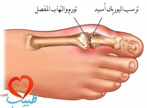 طبيب ع مفاصل ترسب اليوريك اسيد