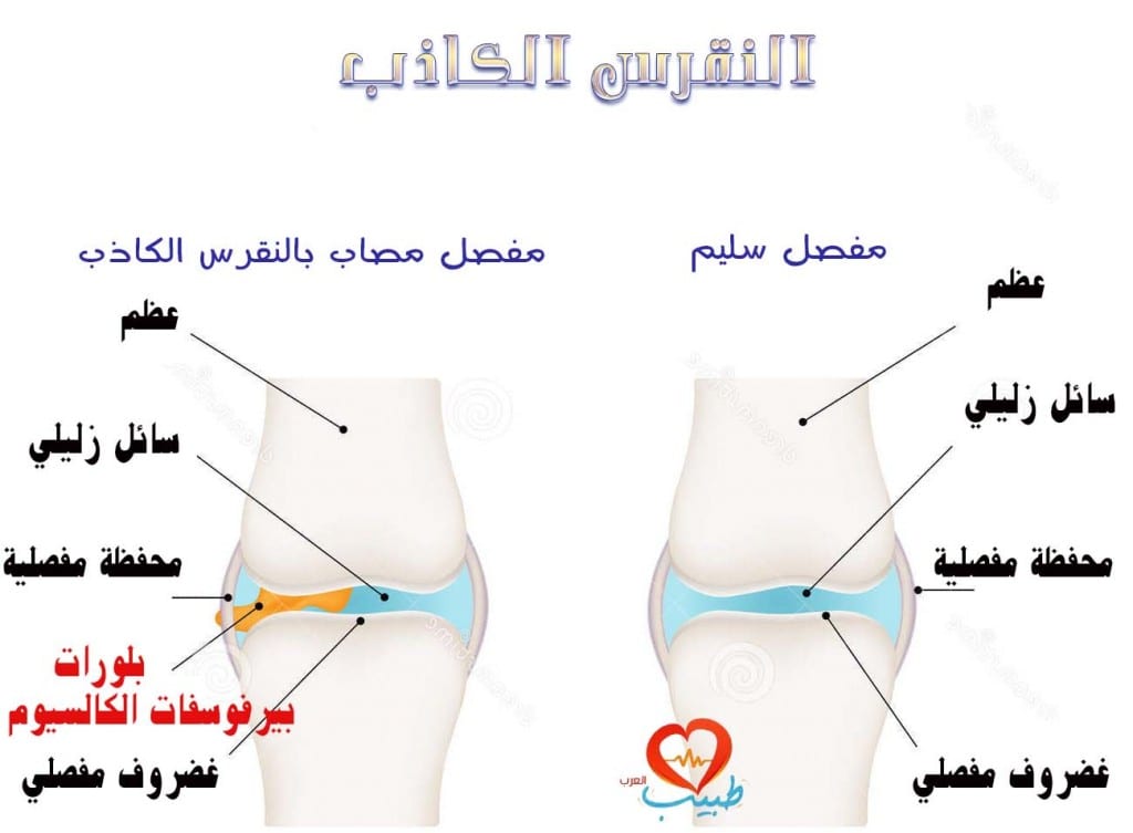 طبيب عرب مفاصل نقرس كاذب