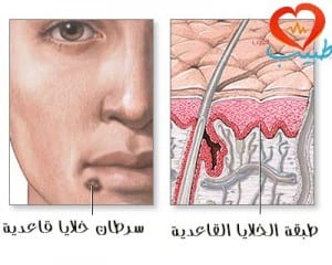 طبيب ع جلدية سرطان خلايا قاعدية