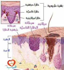 سرطانة الخلايا القاعدية