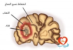 علامات وأعراض سرطان الدماغ