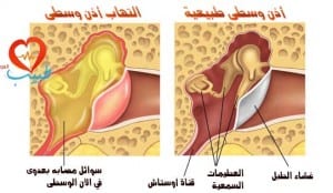 طبيب ع اذن التهاب مصلي 1